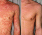 Eczema Relief Skin Treatment Cream for Irritated Skin