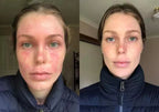 Eczema Relief Cream for Irritated Skin Soothing Treatment