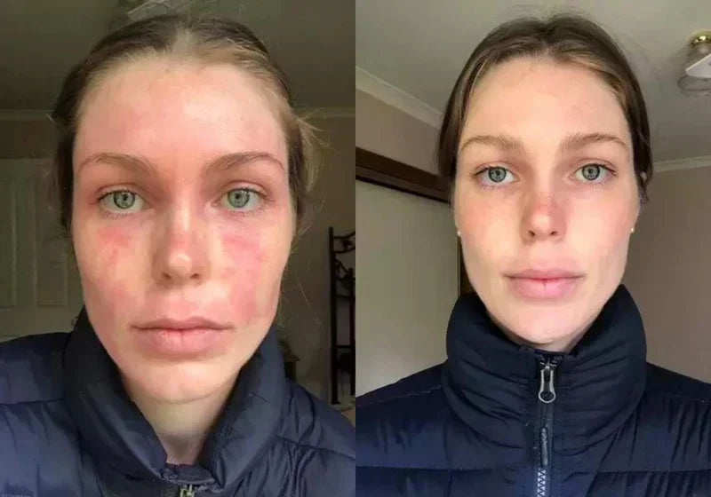Eczema Relief Skin Treatment Cream for Irritated Skin