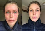 Eczema Relief Skin Treatment Cream for Irritated Skin