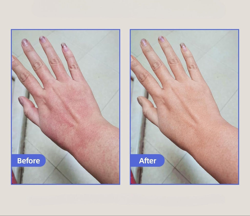 Eczema Relief Skin Treatment Cream for Irritated Skin
