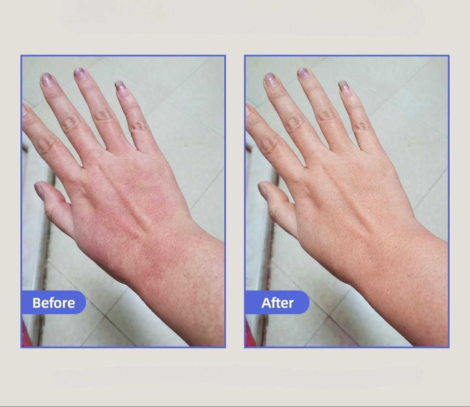 Eczema Relief Skin Treatment Cream for Irritated Skin