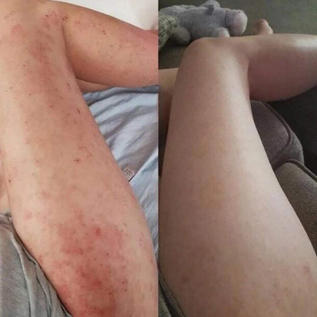 Eczema Relief Skin Treatment Cream for Irritated Skin